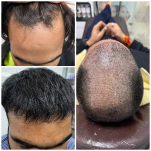Hair Transplant in Rewari