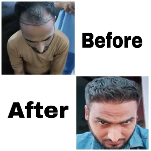 Hair Transplant in Rewari