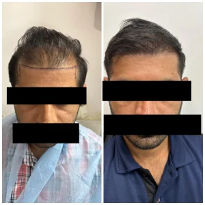 Hair Transplant in Rewari