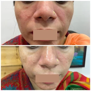 Rosacea Treatment in Rewari