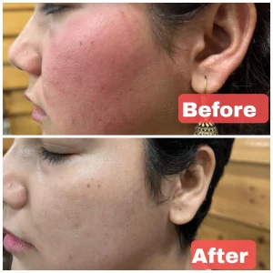 Rosacea Treatment in Rewari