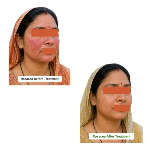 Rosacea Treatment in Rewari