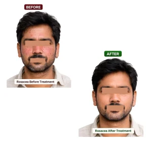 Rosacea Treatment in Rewari