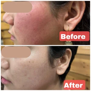 Rosacea Treatment in Rewari